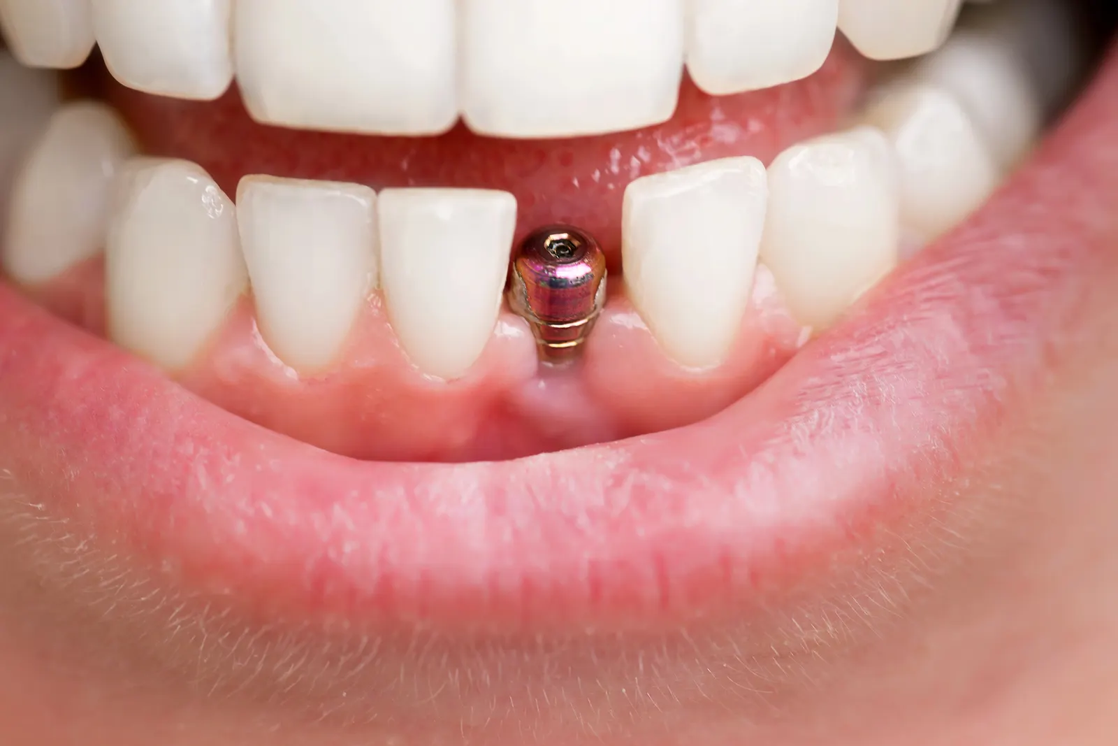 Close-up of lower teeth with a dental implant in the front gap of the gums.
