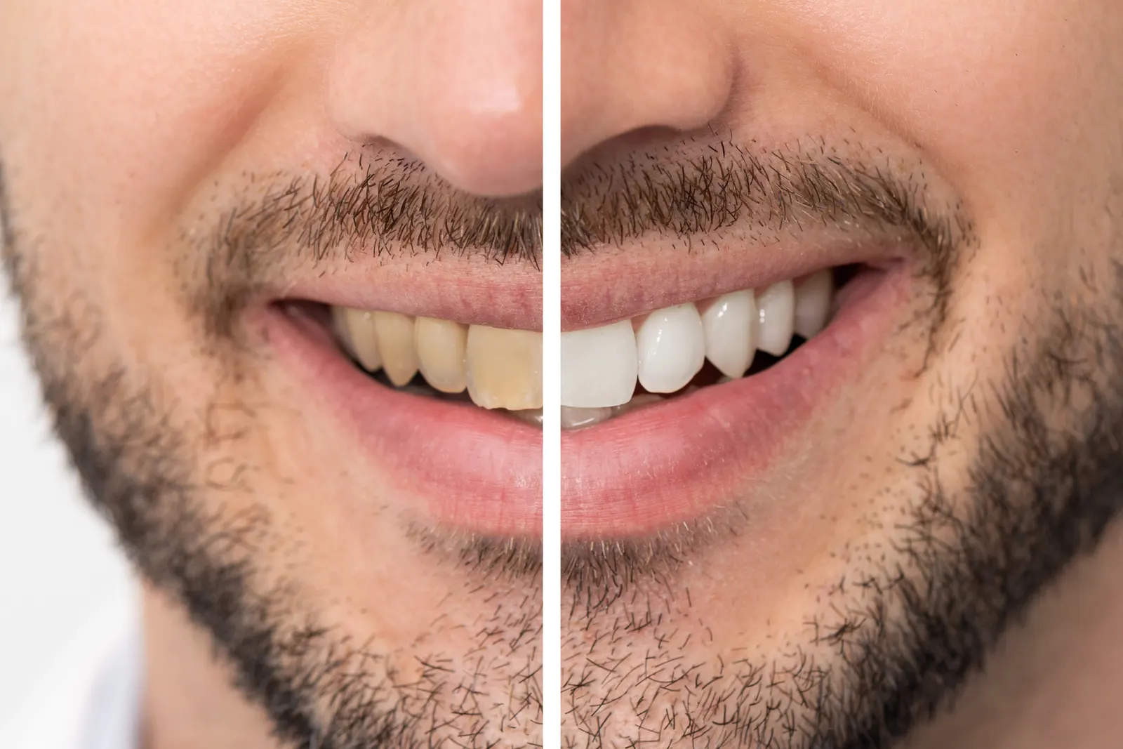 Close-up of a man's smile with teeth half yellowed and half whitened showing whitening effects.