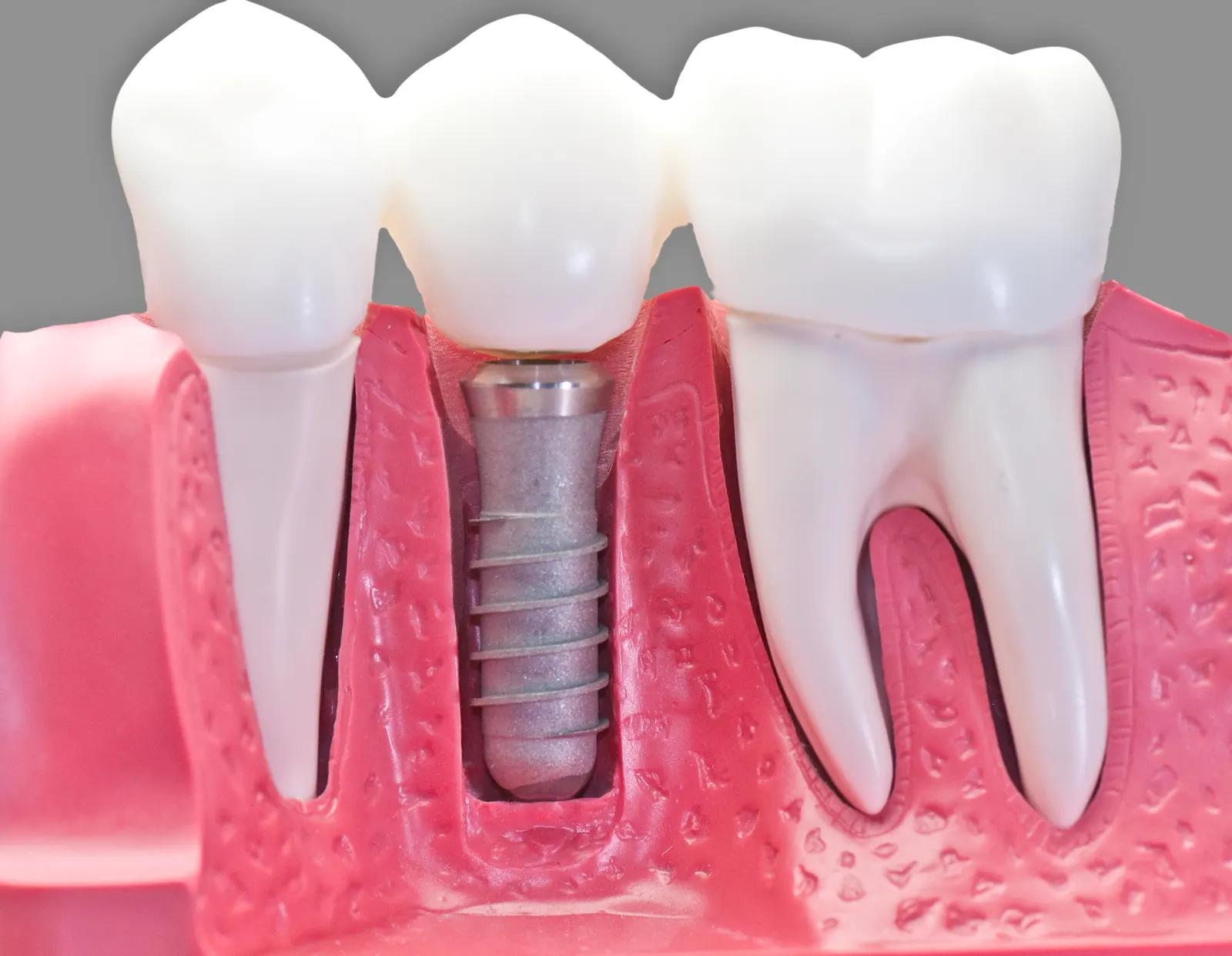 Model of dental implant screw in gums between two natural teeth with roots.