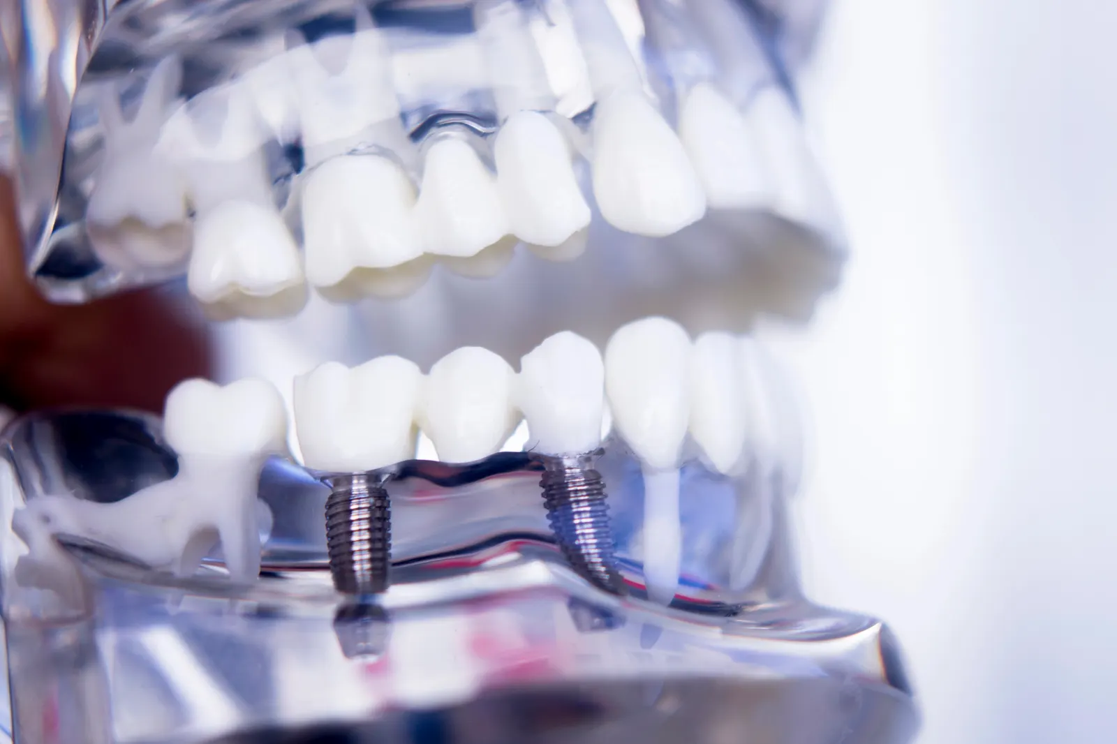 Model of dental implants in lower jaw with artificial teeth on transparent jaw model.