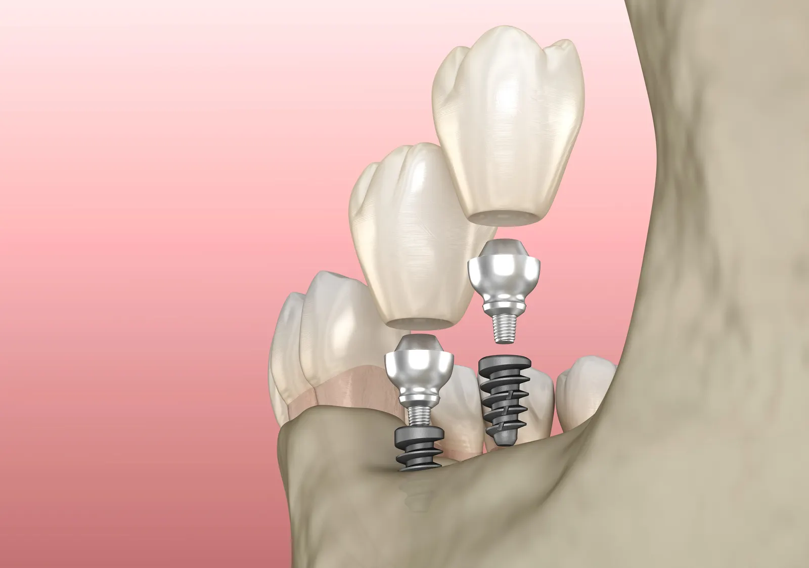 3D rendering of dental implants with abutments and crowns in the jawbone against pink background.