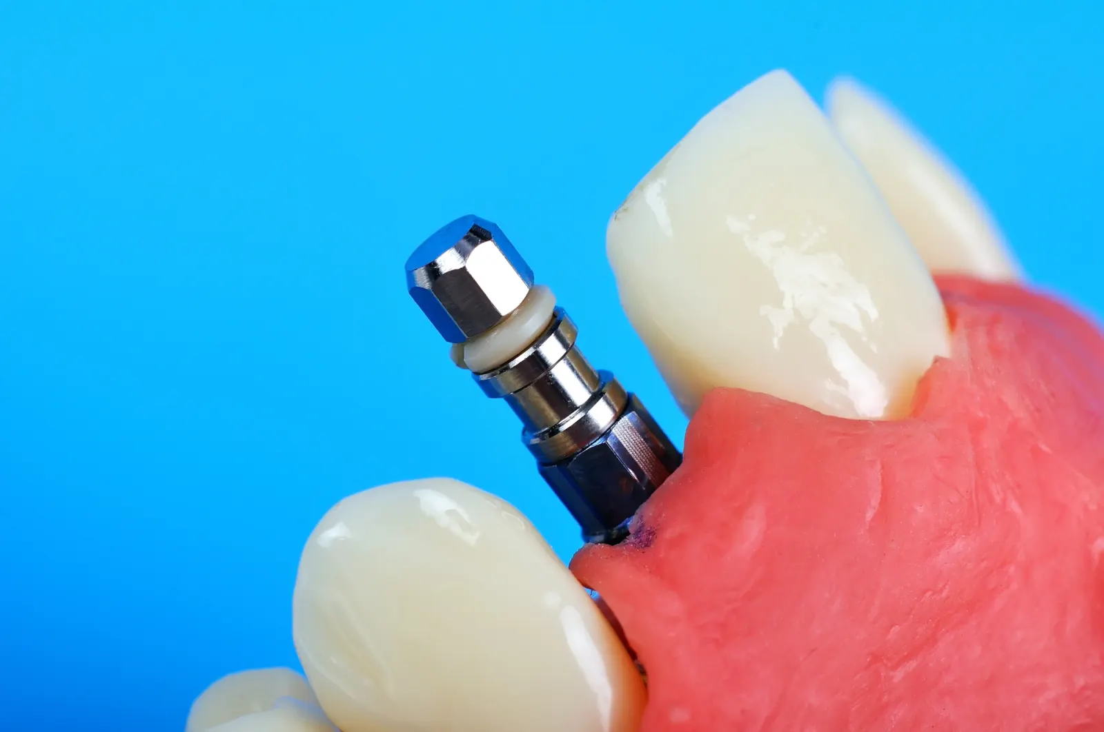 Close-up of dental implant attached to artificial gums next to two artificial teeth on a blue background.