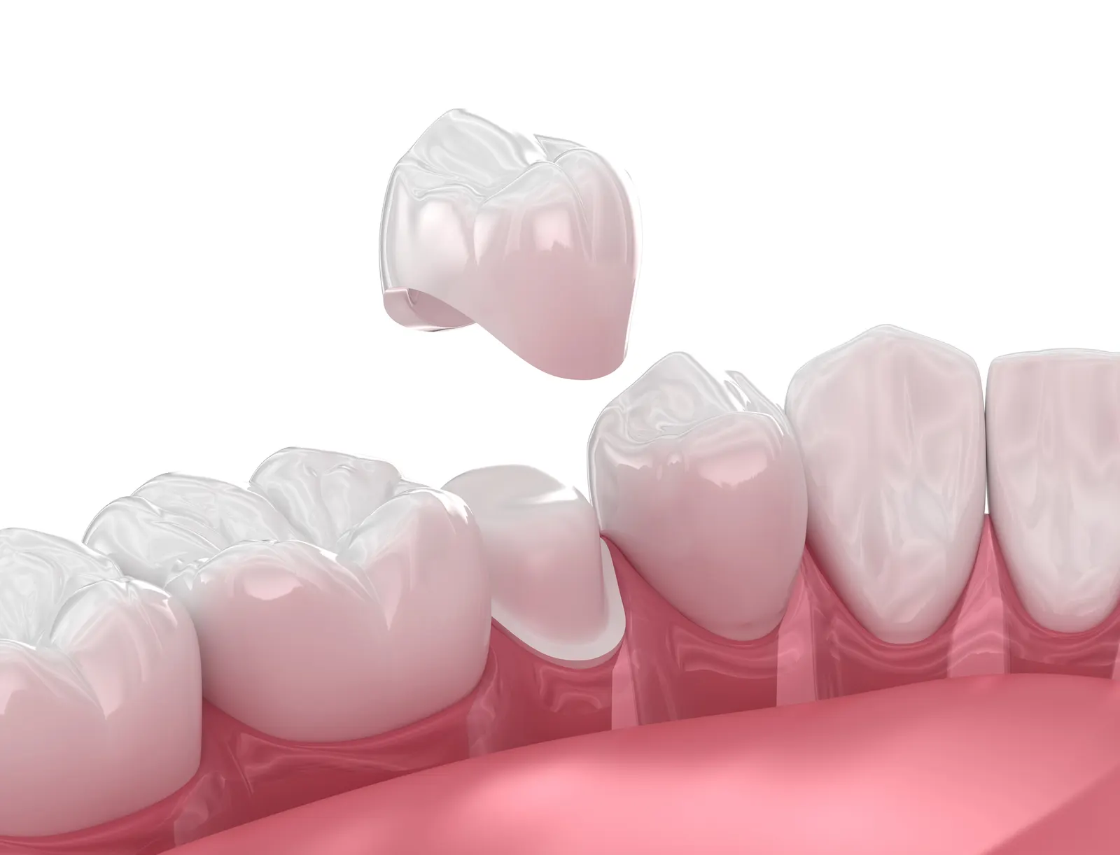 Dental crown being placed on a prepared tooth among healthy gums and adjacent teeth.