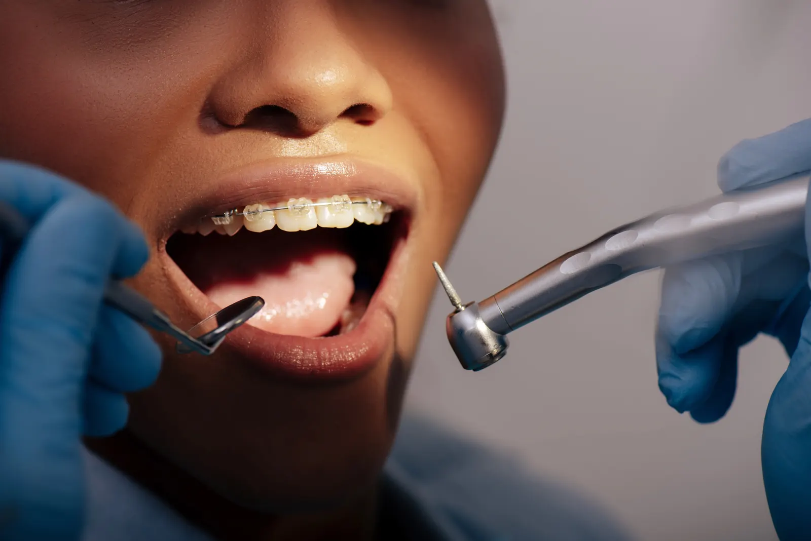 Close-up of a person with braces undergoing dental cleaning with tools held by a gloved dentist.
